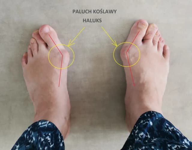 Haluks przyczyny: Jak unikać bólu i skutków haluksów w codziennym życiu Haluks przyczyny: Jak unikać bólu i skutków haluksów w codziennym życiu
