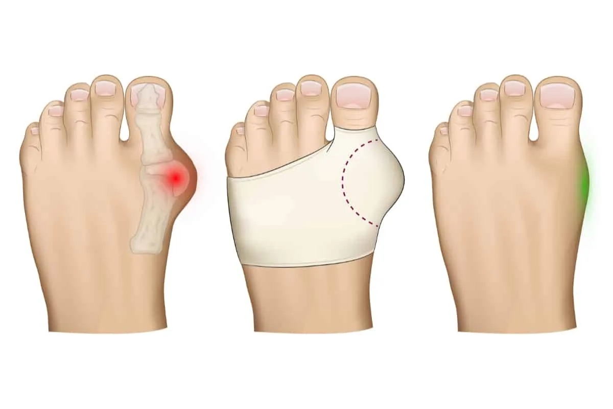 Jak zapobiec haluksom i uniknąć bólu stóp dzięki prostym sposobom